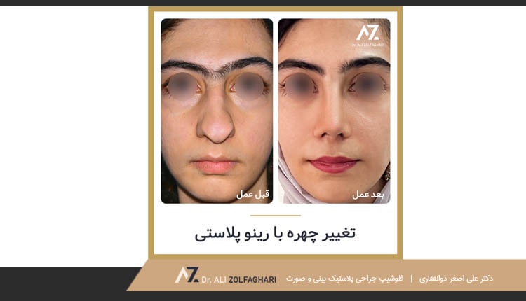 تغییر چهره با رینوپلاستی