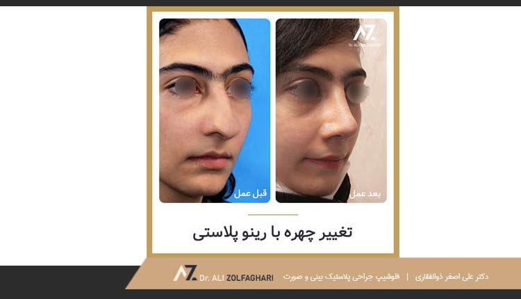 نمونه کارهای عمل بینی دکتر علی اصغر ذوالفقاری