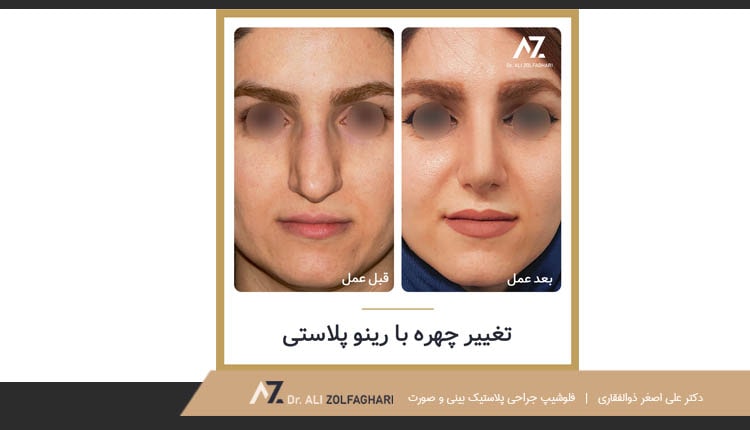 نمونه کار جراحی زیبایی بینی