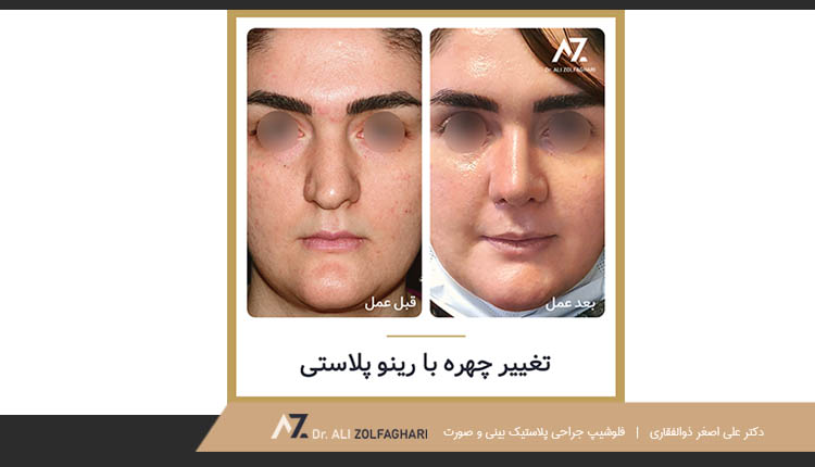 نمونه کار رینوپلاستی دکتر ذوالفقاری