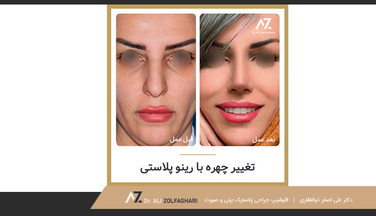 نمونه کار عمل زیبایی بینی