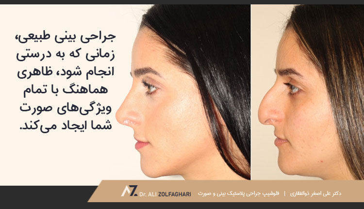 رینوپلاستی طبیعی چیست