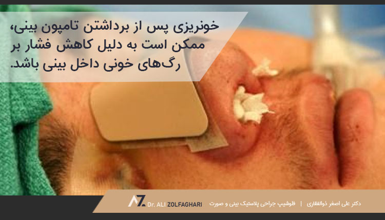 خونریزی بعد از درآوردن تامپون بینی