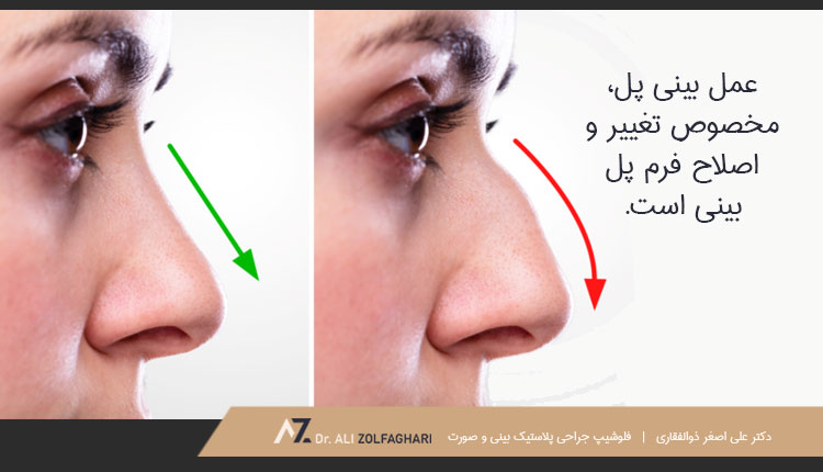 عمل پل بینی برای اصلاح فرم بینی