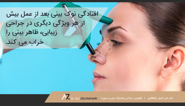 چه مدت بعد از جراحی بینی نوک بینی افتادگی پیدا می کند