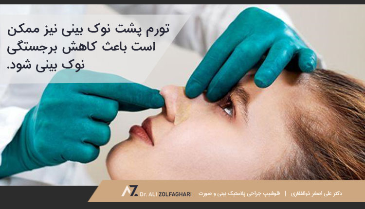 علل افتادگی نوک بینی بعد از عمل