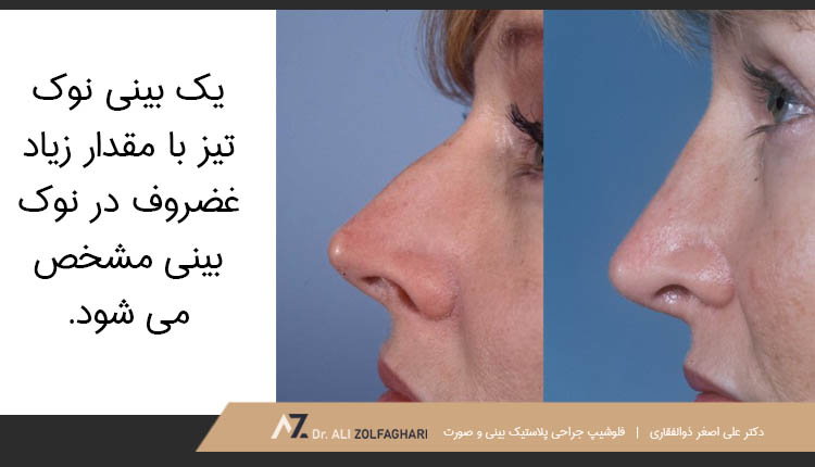 یک بینی نوک تیز با مقدار زیاد غضروف در نوک بینی مشخص میشود