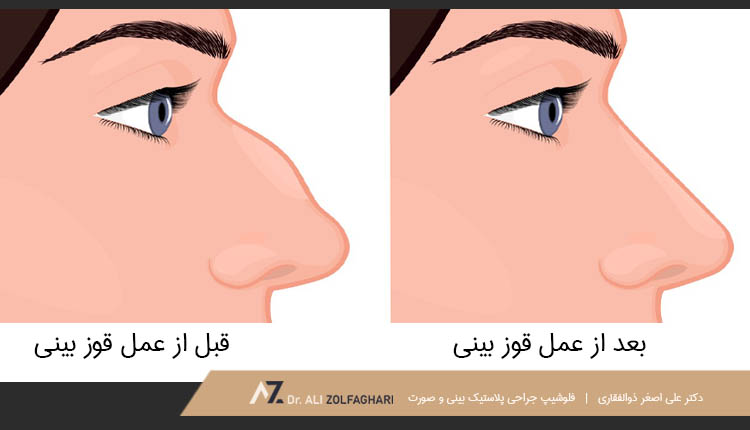قبل و بعد از عمل قوز بینی