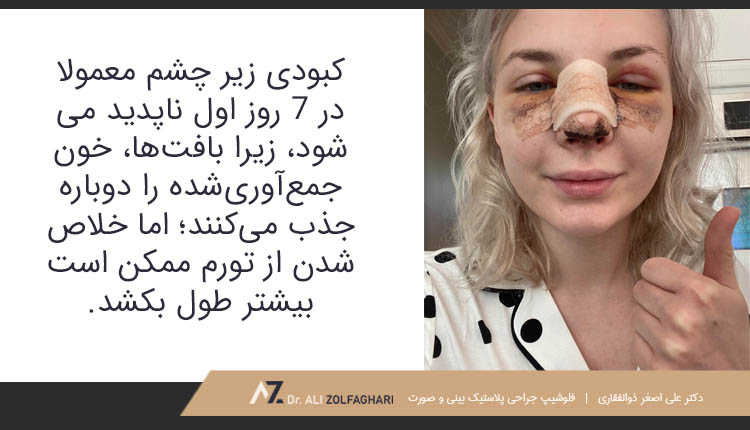 کبودی زیر چشم بعد از عمل بینی