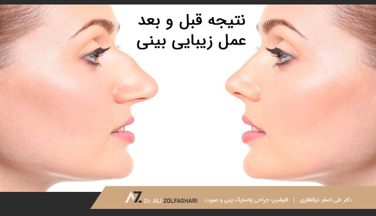 نتیجه قبل و بعد عمل زیبایی بینی