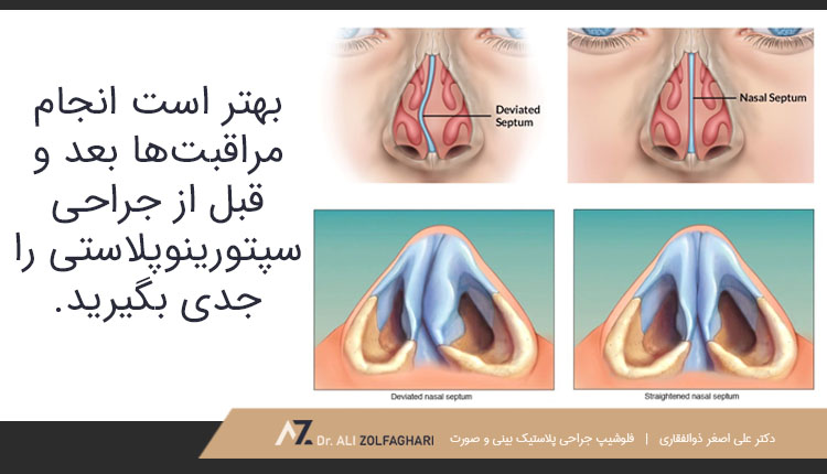 انجام مراقبت‌ها بعد و قبل از جراحی سپتورینوپلاستی | رفع مشکل تنفسی با عمل جراحی سپتورینوپلاستی