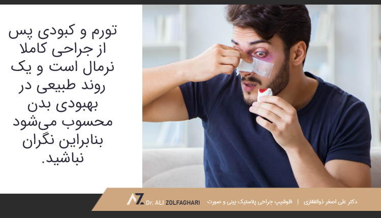 تورم و کبودی پس از جراحی بینی کاملا نرمال است و یک روند طبیعی در بهبودی بدن محسوب می‌شود