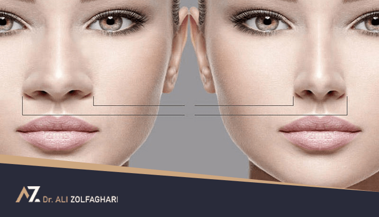 عمل بینی گوشتی | عمل بینی گوشتی چگونه انجام می‌شود؟