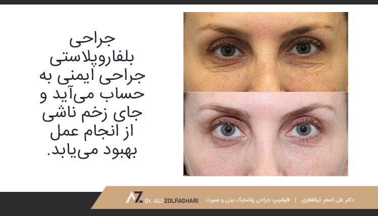 آیا اسکار بلفاروپلاستی روی صورت من باقی خواهد ماند؟