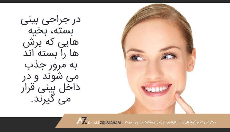 بخیه در جراحی بینی به روش بسته