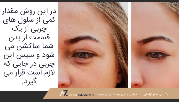 تزریق چربی پشت پلک چیست؟