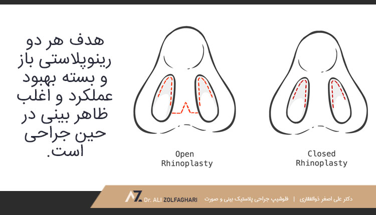 تفاوت های اصلی بین جراحی بینی باز و بسته