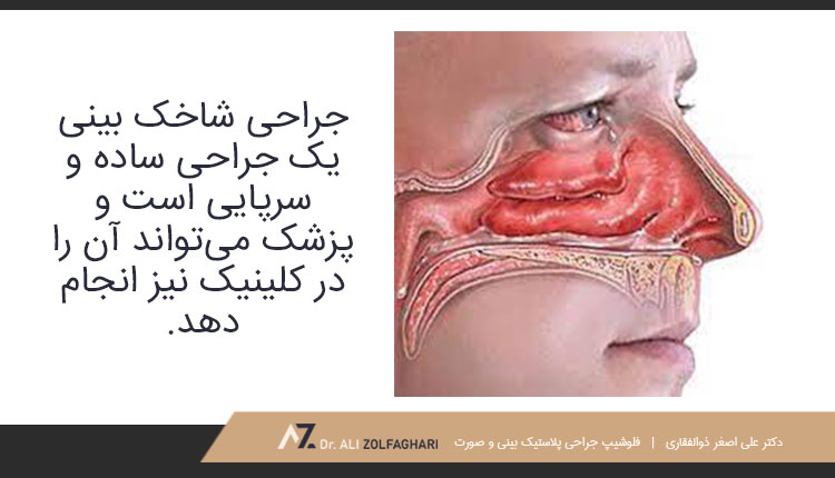 جراحی شاخک بینی چگونه انجام می‌شود؟