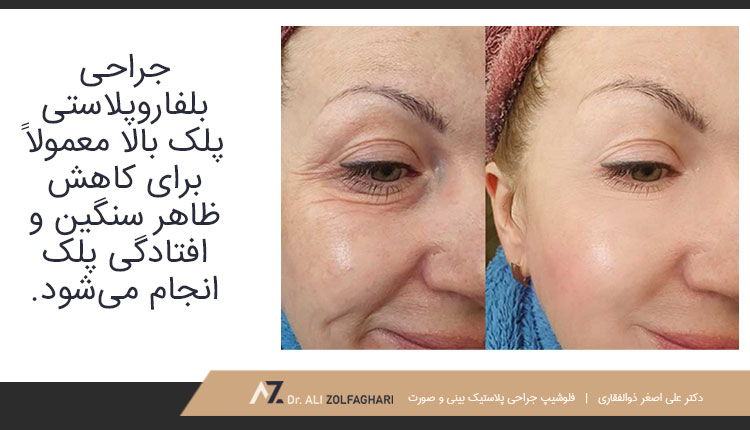 جراحی-لیزر-پلک-بالا