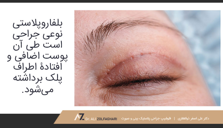 جراحی پلک چیست و چرا انجام می شود؟