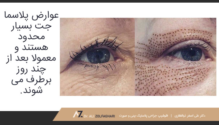 عوارض پلاسما جت پلک