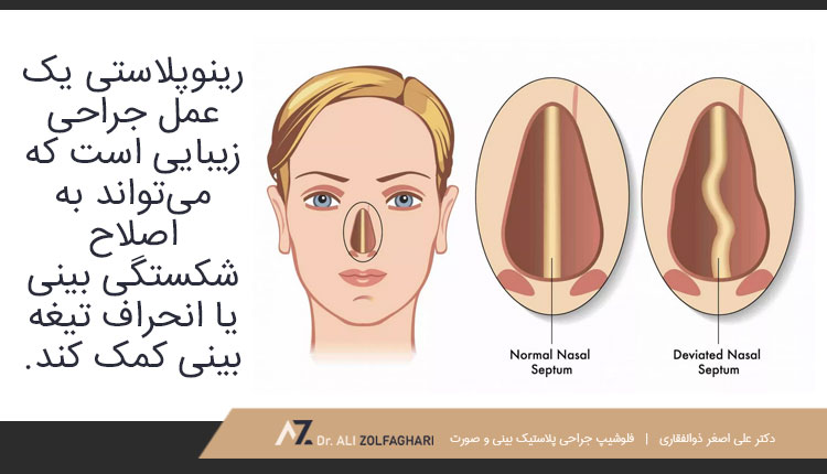 با کمک عمل رینوپلاستی می توان شکستگی بینی را اصلاح کرد