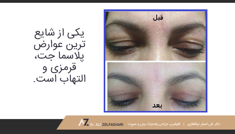 عوارض جانبی پلاسما جت پلک چیست؟