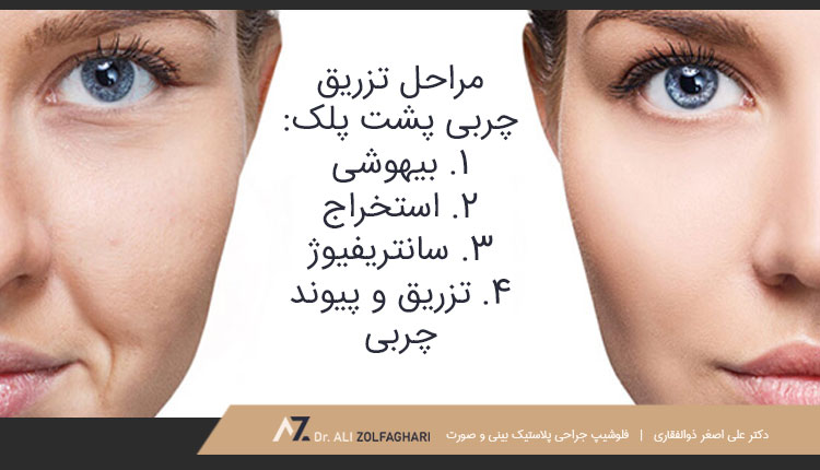 مراحل تزریق چربی به پشت پلک