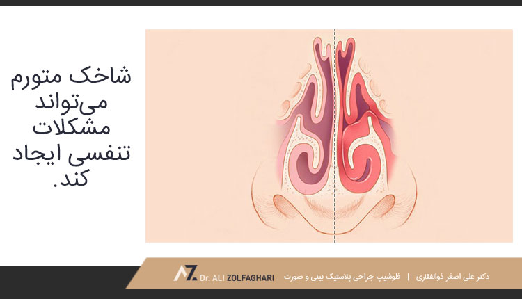 شاخک متورم می‌تواند مشکلات تنفسی ایجاد کند.