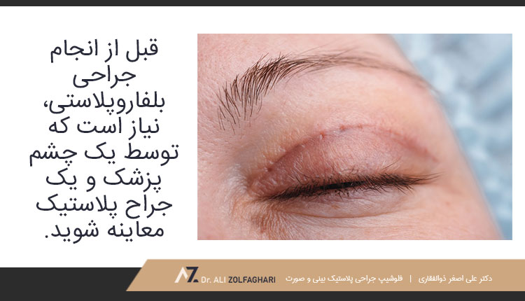 چگونه برای انجام جراحی بلفاروپلاستی آماده شویم؟