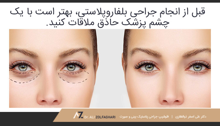 چگونه برای انجام جراحی پلک آماده شویم؟