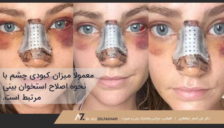 ارتباط کبودی چشم بعد از عمل بینی با نحوه اصلاح استخوان بینی