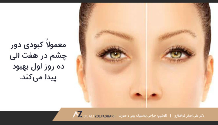 کبودی چشم پس از عمل بینی تا چه مدت ادامه خواهد داشت