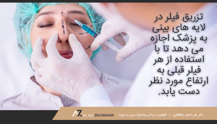 روند انجام تزریق فیلر بینی