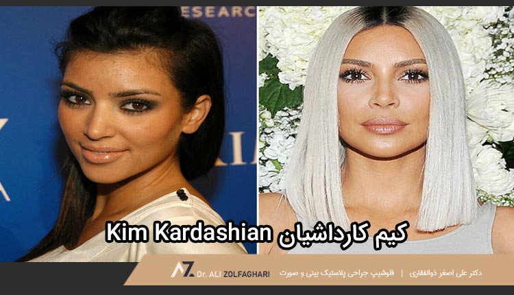 عمل بینی بازیگر محبوب کیم کارداشیان | جراحی بینی بازیگران و افراد مشهور
