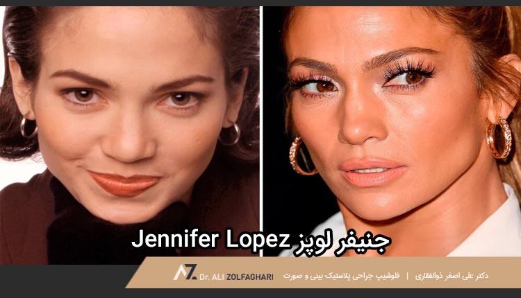عمل بینی جنیفر لوپز |جراحی بینی بازیگران و افراد مشهور