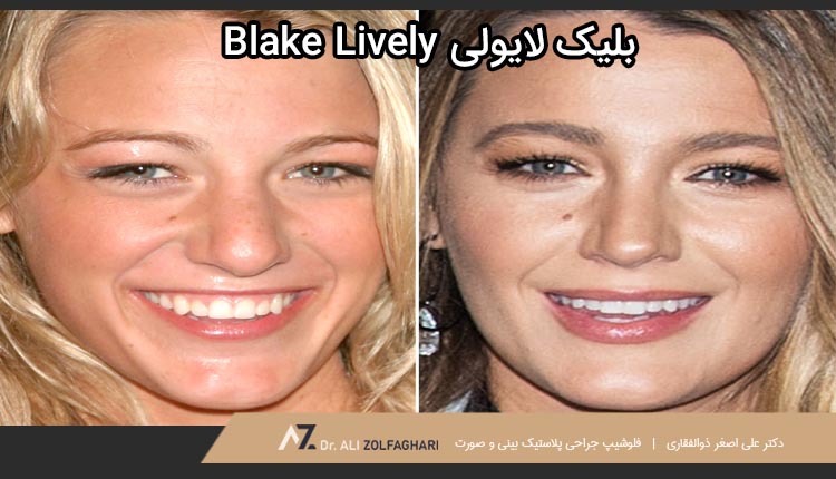 عمل بینی بلیک لایولی