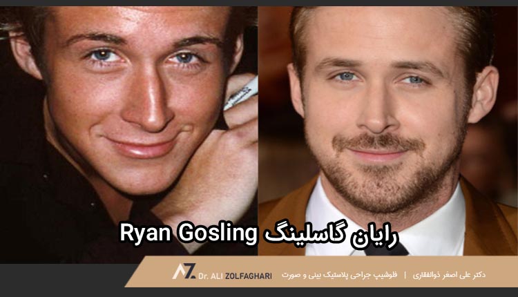 عمل زیبایی رایان گاسلینگ | جراحی بینی بازیگران و افراد مشهور