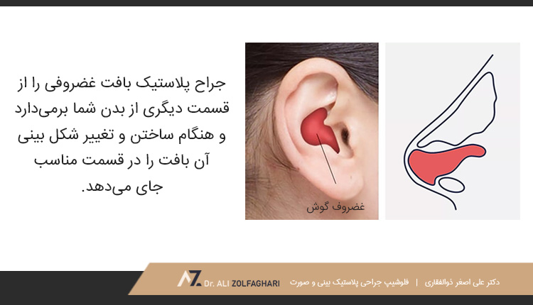 پیوند غضروف گوش در عمل جراحی بینی