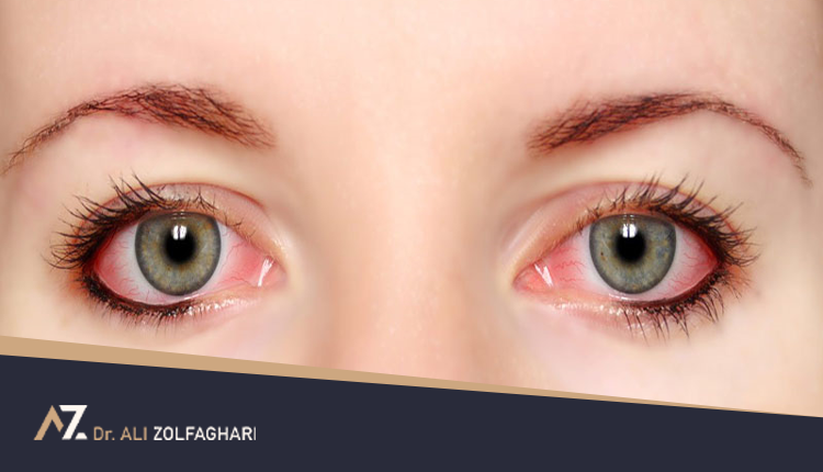 قرمزی چشم بعد از عمل بینی
