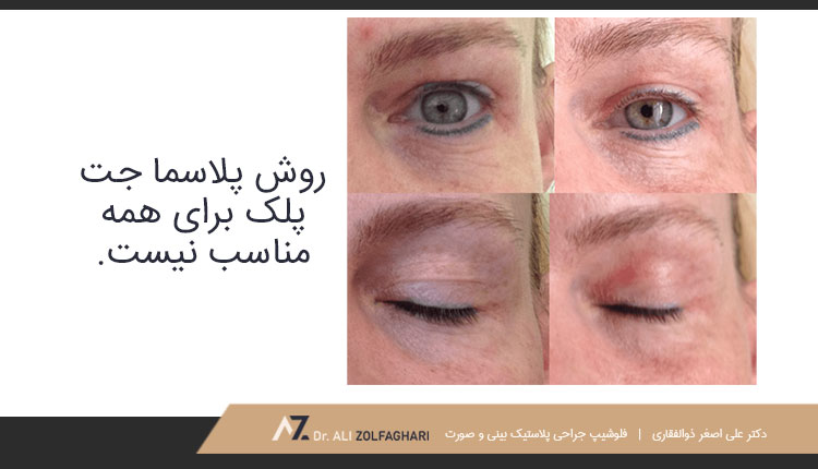کاندیدای پلاسماجت