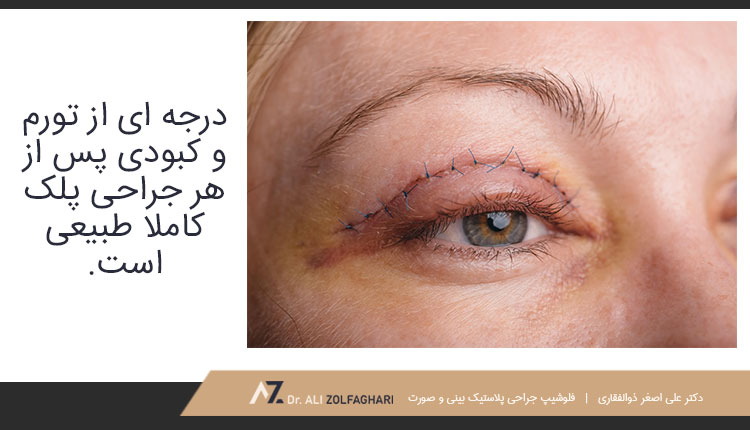 ایا تورم پس از عمل جراحی پلک طبیعی است؟
