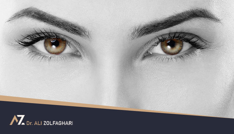 جراحی زیبایی کانتوپلاستی (Canthoplasty) یا عمل چشم گربه ای