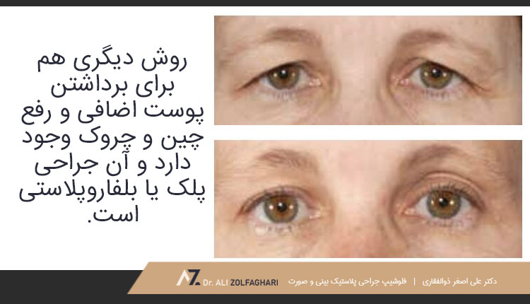 جراحی پلک برای برداشتن پوست اضافی