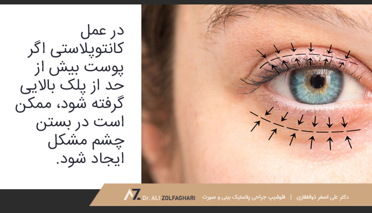 عوارض جانبی جراحی زیبایی کانتوپلاستی