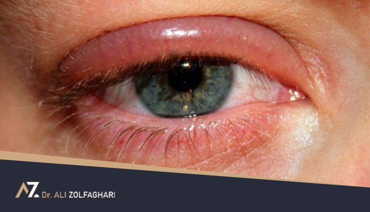 التهاب پلک چشم (بلفاریت) چیست و چه علائمی دارد؟