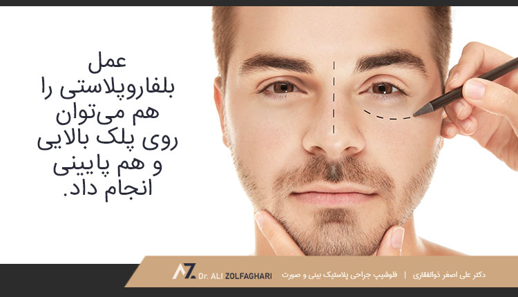 عمل بلفاروپلاستی