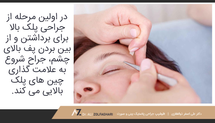 مراحل انجام عمل بلفاروپلاستی پف بالای چشم