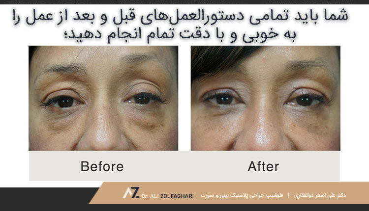 نحوه پیشگیری از عوارض ناخواسته پس از عمل بلفاروپلاستی