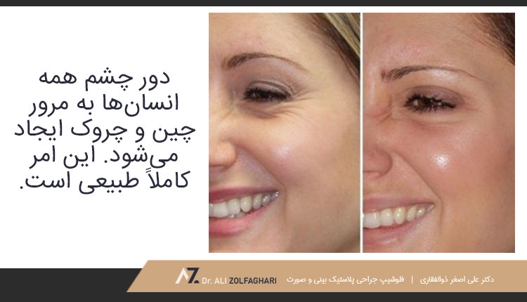 چرا دور چشم چین و چروک ایجاد می‌شود؟